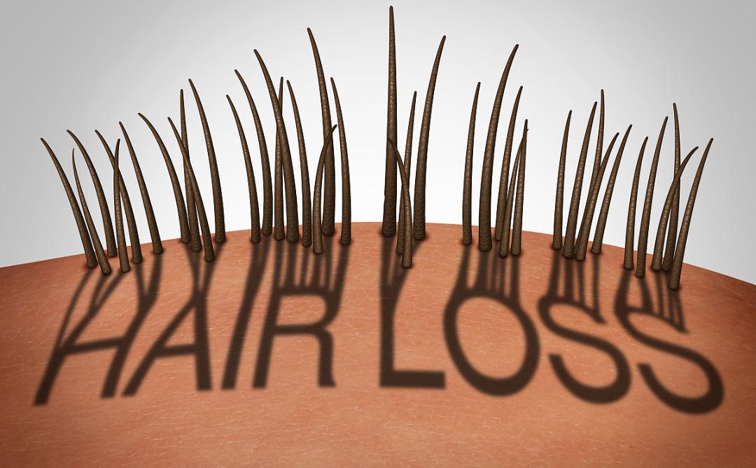 “秃了”的90后，该如何拯救自己的发际线？