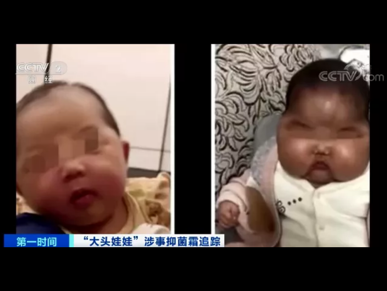 追踪！“大头娃娃”涉事抑菌霜被质疑含超强效激素！或抑制孩子生长...